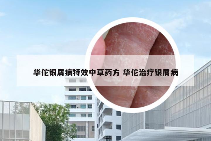 华佗银屑病特效中草药方 华佗治疗银屑病