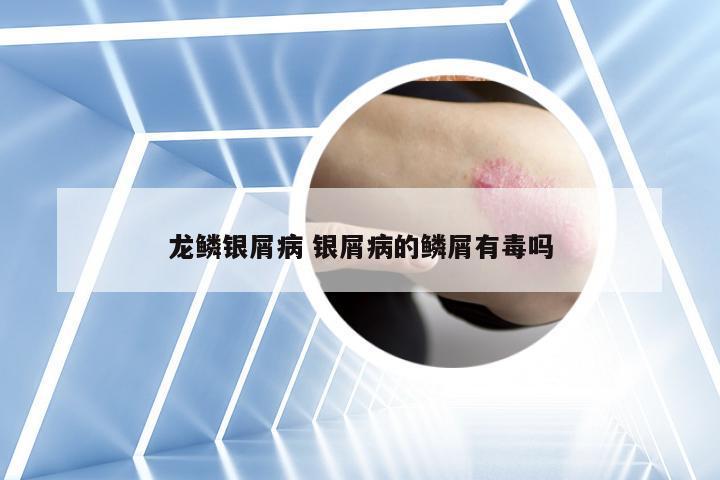 龙鳞银屑病 银屑病的鳞屑有毒吗