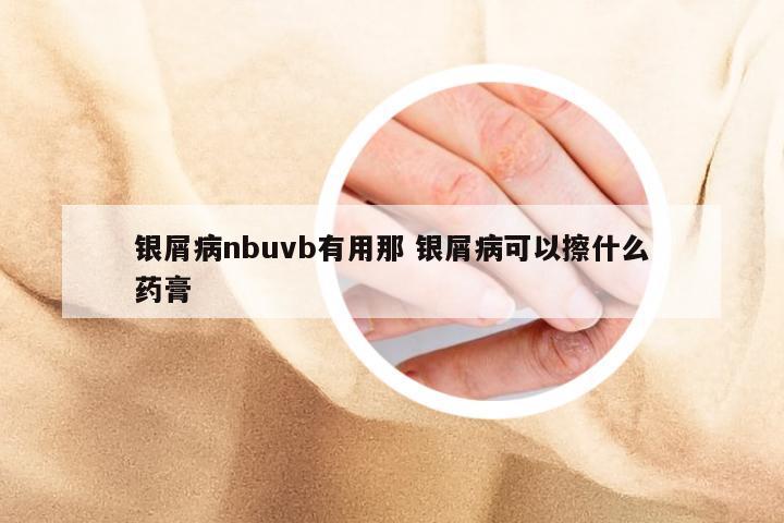 银屑病nbuvb有用那 银屑病可以擦什么药膏