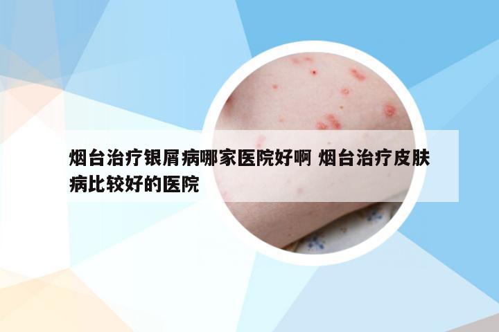 烟台治疗银屑病哪家医院好啊 烟台治疗皮肤病比较好的医院