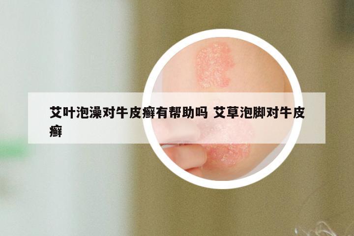 艾叶泡澡对牛皮癣有帮助吗 艾草泡脚对牛皮癣