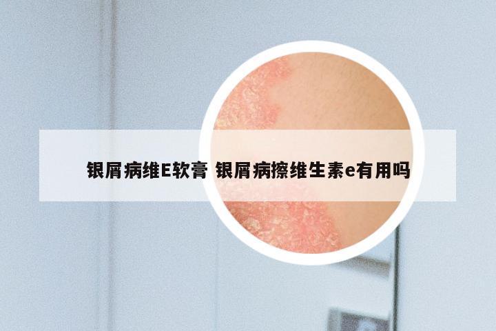 银屑病维E软膏 银屑病擦维生素e有用吗