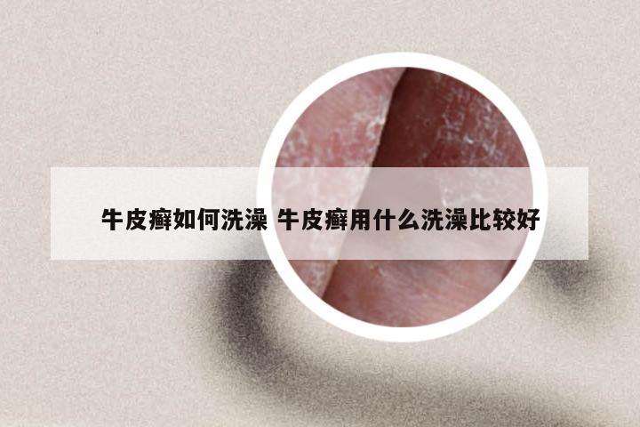 牛皮癣如何洗澡 牛皮癣用什么洗澡比较好