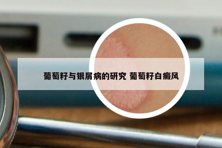 葡萄籽与银屑病的研究 葡萄籽白癜风