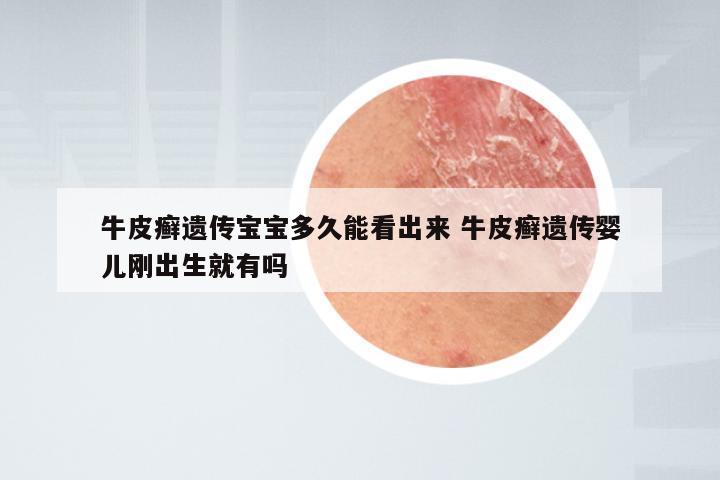 牛皮癣遗传宝宝多久能看出来 牛皮癣遗传婴儿刚出生就有吗