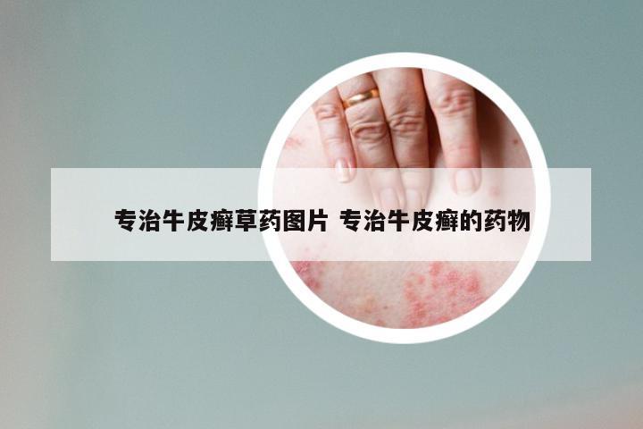 专治牛皮癣草药图片 专治牛皮癣的药物