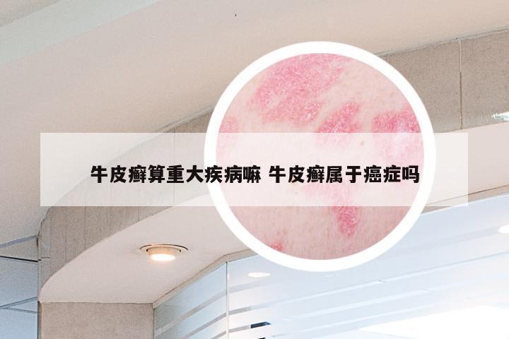 牛皮癣算重大疾病嘛 牛皮癣属于癌症吗