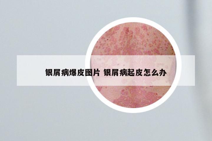 银屑病爆皮图片 银屑病起皮怎么办