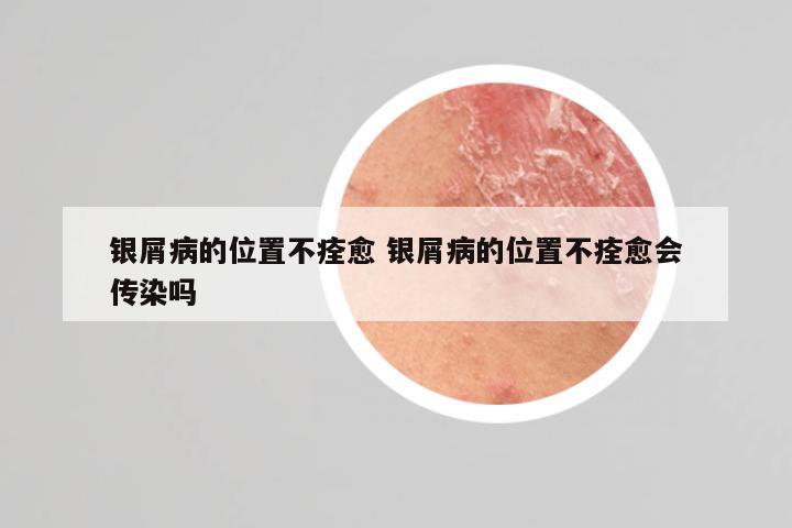 银屑病的位置不痊愈 银屑病的位置不痊愈会传染吗