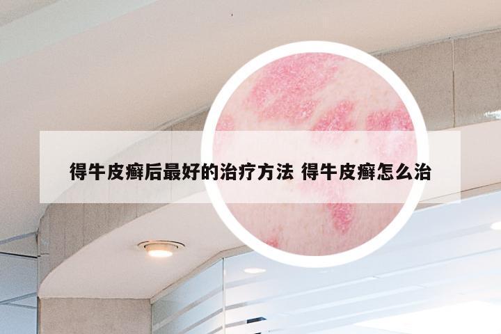 得牛皮癣后最好的治疗方法 得牛皮癣怎么治