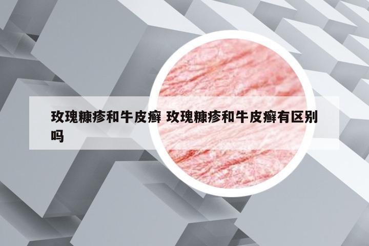 玫瑰糠疹和牛皮癣 玫瑰糠疹和牛皮癣有区别吗