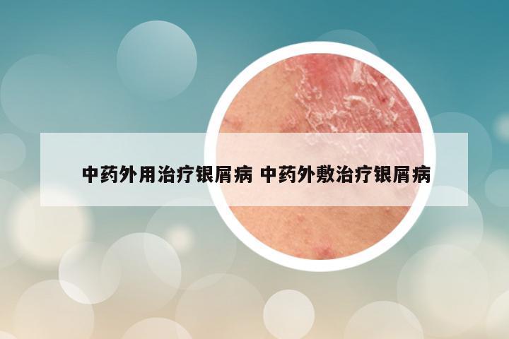 中药外用治疗银屑病 中药外敷治疗银屑病