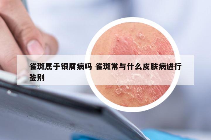 雀斑属于银屑病吗 雀斑常与什么皮肤病进行鉴别