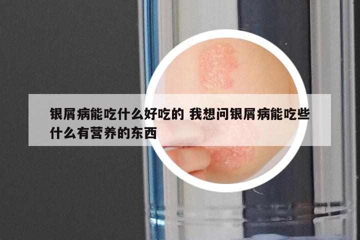 银屑病能吃什么好吃的 我想问银屑病能吃些什么有营养的东西