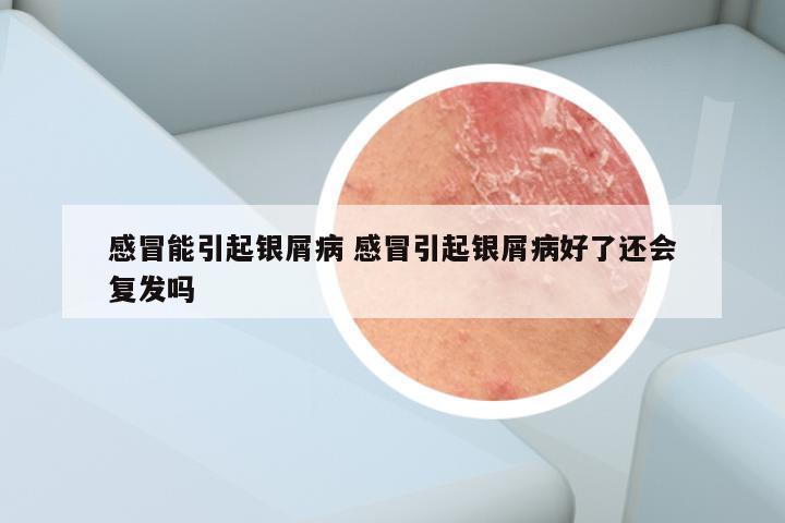 感冒能引起银屑病 感冒引起银屑病好了还会复发吗