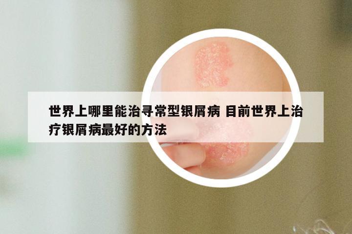世界上哪里能治寻常型银屑病 目前世界上治疗银屑病最好的方法