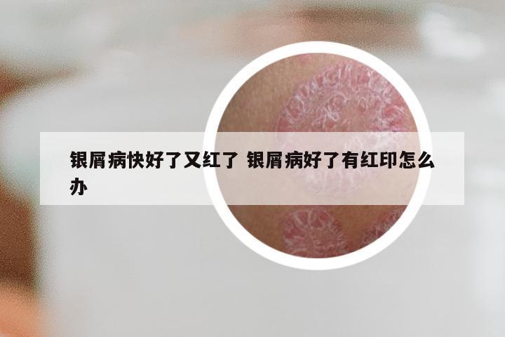 银屑病快好了又红了 银屑病好了有红印怎么办