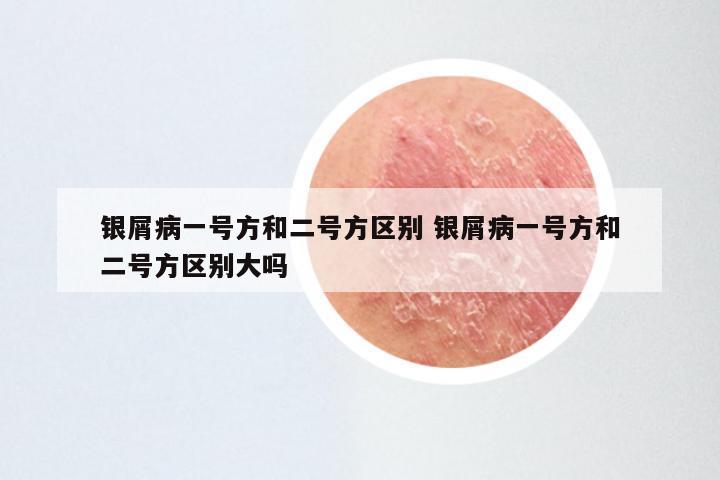 银屑病一号方和二号方区别 银屑病一号方和二号方区别大吗