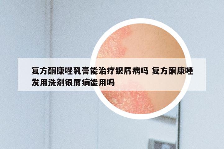 复方酮康唑乳膏能治疗银屑病吗 复方酮康唑发用洗剂银屑病能用吗