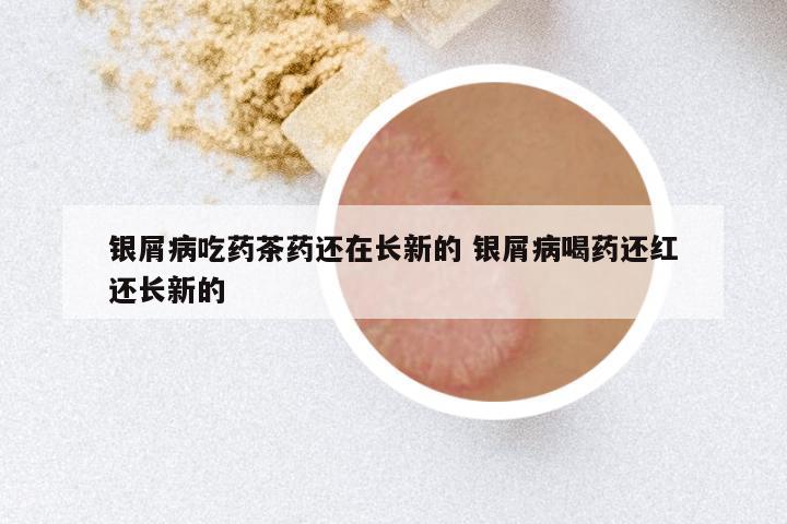 银屑病吃药茶药还在长新的 银屑病喝药还红还长新的
