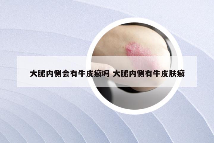大腿内侧会有牛皮癣吗 大腿内侧有牛皮肤癣