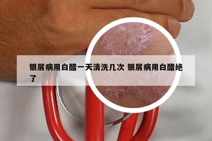 银屑病用白醋一天清洗几次 银屑病用白醋绝了
