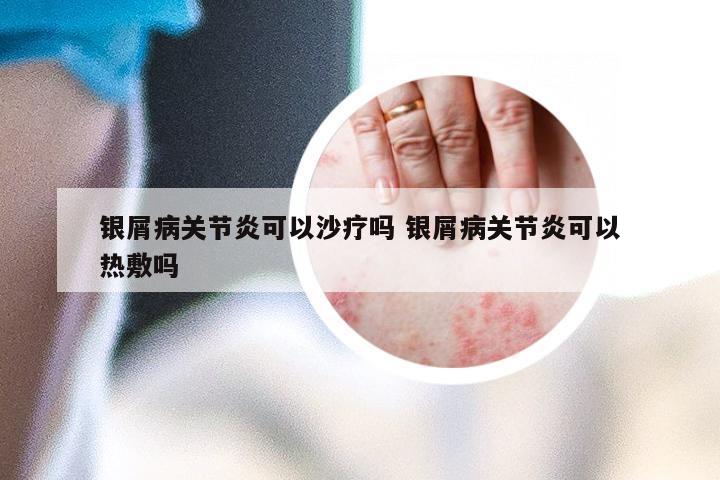 银屑病关节炎可以沙疗吗 银屑病关节炎可以热敷吗