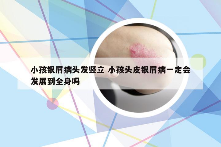 小孩银屑病头发竖立 小孩头皮银屑病一定会发展到全身吗