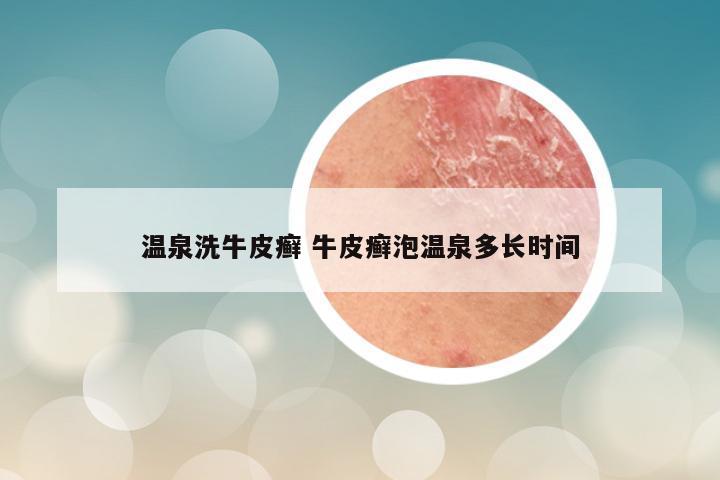 温泉洗牛皮癣 牛皮癣泡温泉多长时间