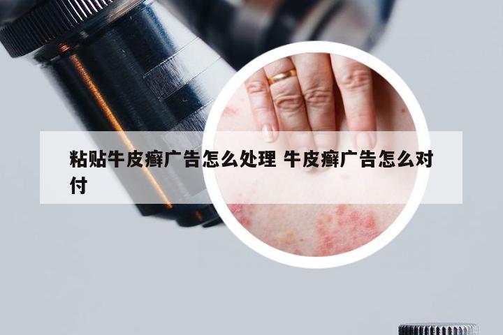 粘贴牛皮癣广告怎么处理 牛皮癣广告怎么对付