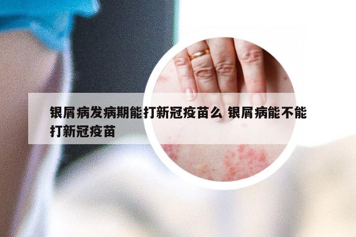银屑病发病期能打新冠疫苗么 银屑病能不能打新冠疫苗