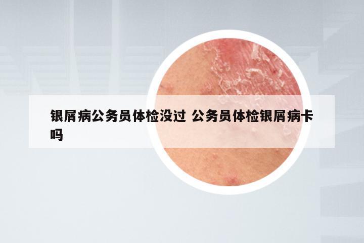 银屑病公务员体检没过 公务员体检银屑病卡吗