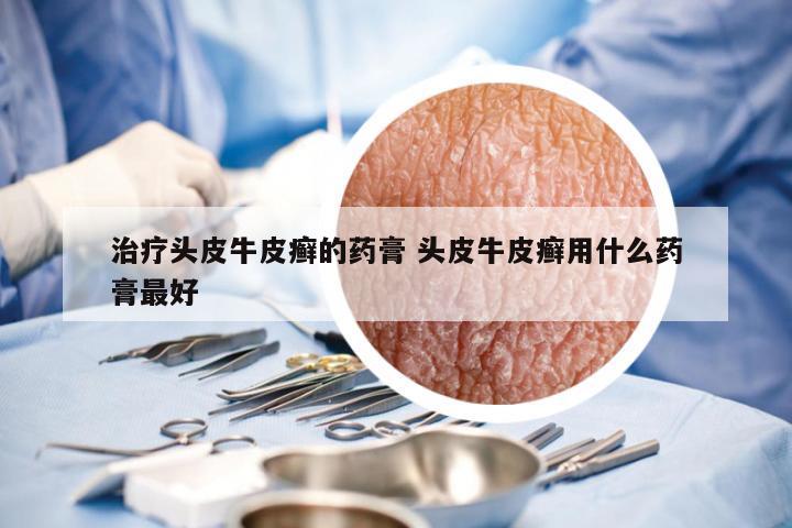 治疗头皮牛皮癣的药膏 头皮牛皮癣用什么药膏最好