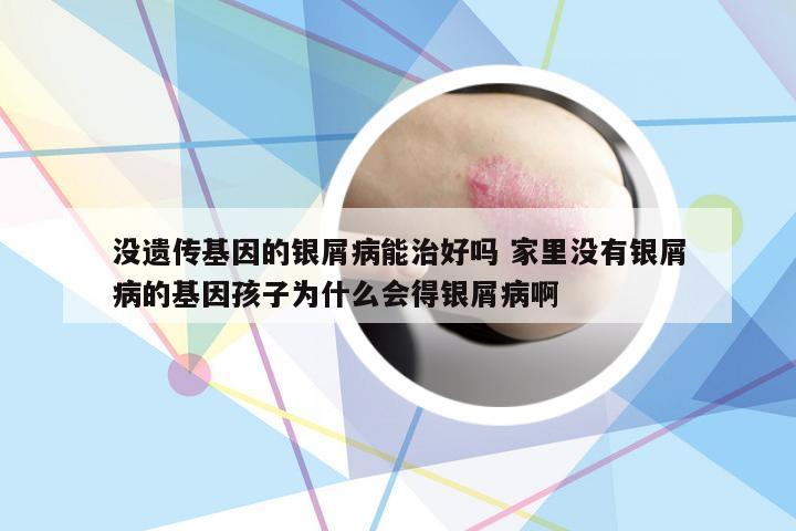 没遗传基因的银屑病能治好吗 家里没有银屑病的基因孩子为什么会得银屑病啊