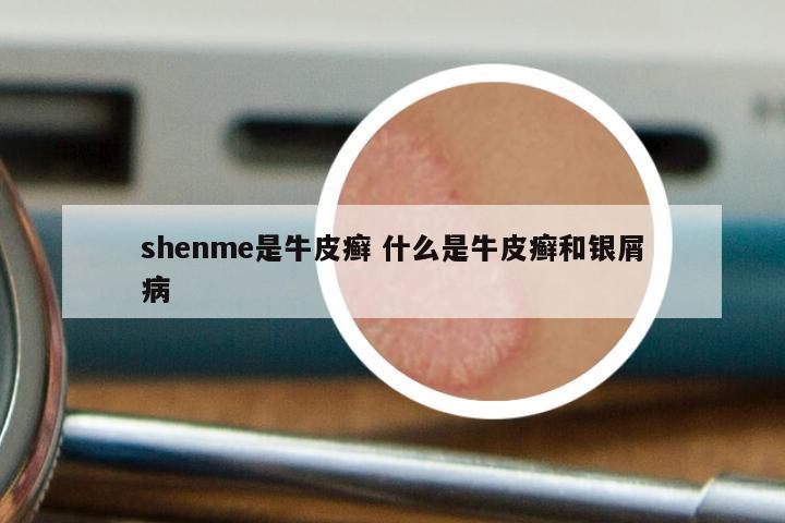 shenme是牛皮癣 什么是牛皮癣和银屑病