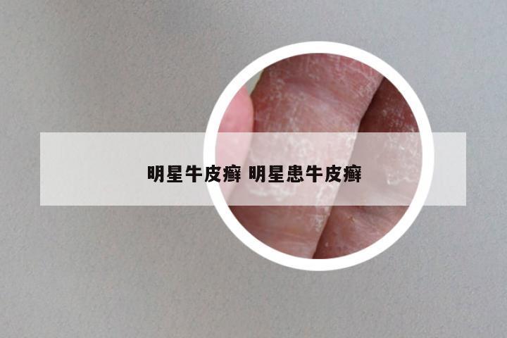 明星牛皮癣 明星患牛皮癣