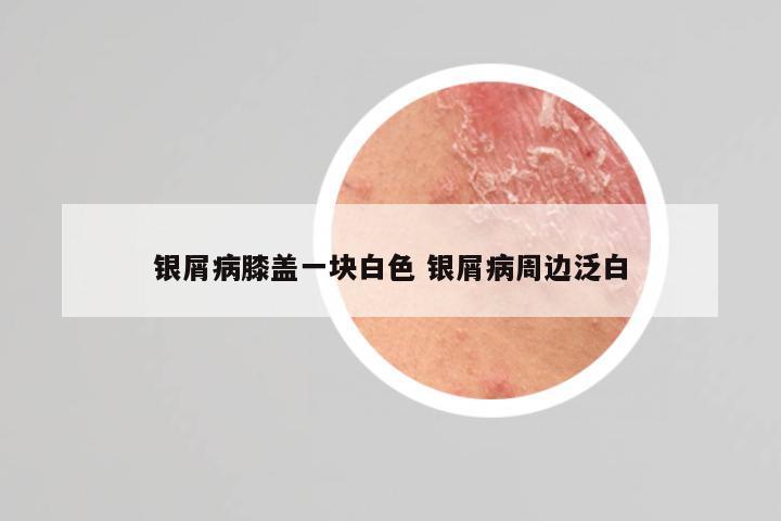 银屑病膝盖一块白色 银屑病周边泛白
