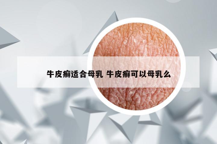 牛皮癣适合母乳 牛皮癣可以母乳么