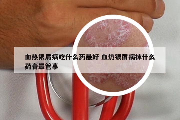 血热银屑病吃什么药最好 血热银屑病抹什么药膏最管事
