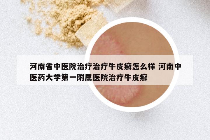 河南省中医院治疗治疗牛皮癣怎么样 河南中医药大学第一附属医院治疗牛皮癣