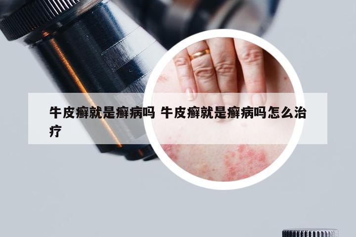 牛皮癣就是癣病吗 牛皮癣就是癣病吗怎么治疗