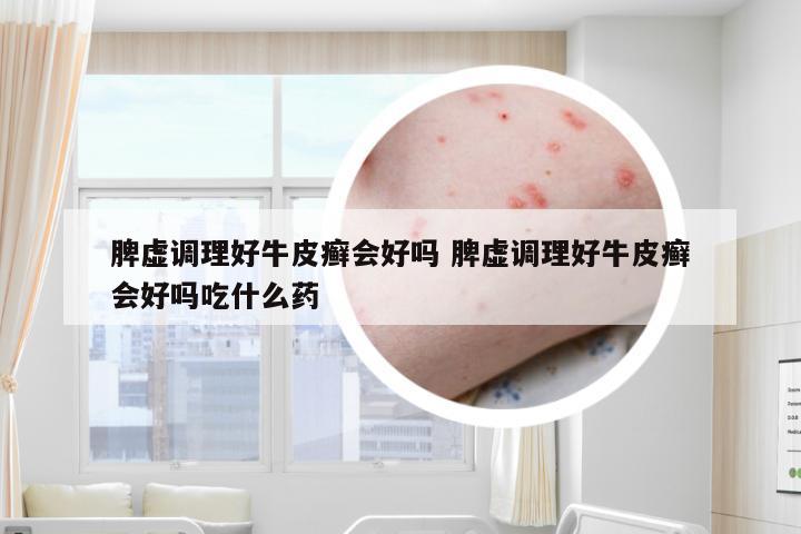 脾虚调理好牛皮癣会好吗 脾虚调理好牛皮癣会好吗吃什么药