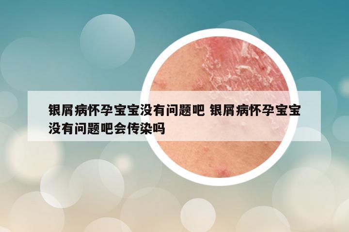 银屑病怀孕宝宝没有问题吧 银屑病怀孕宝宝没有问题吧会传染吗