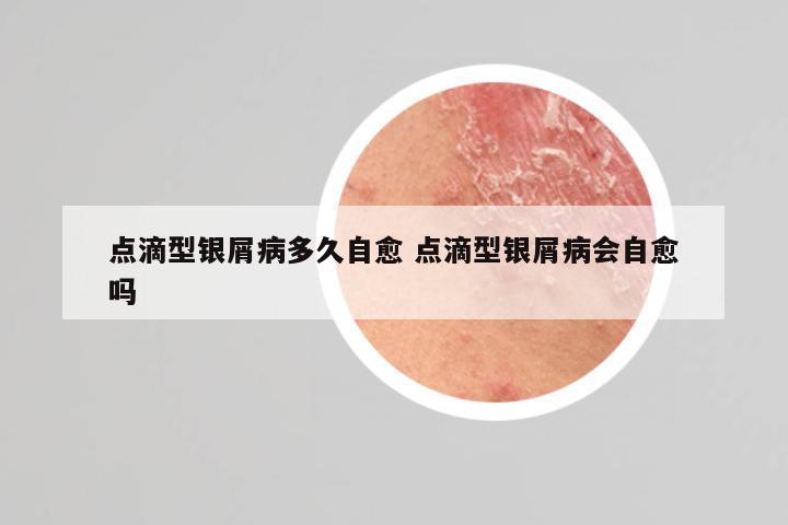 点滴型银屑病多久自愈 点滴型银屑病会自愈吗