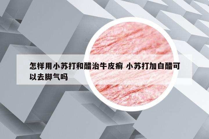 怎样用小苏打和醋治牛皮癣 小苏打加白醋可以去脚气吗