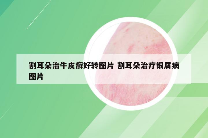 割耳朵治牛皮癣好转图片 割耳朵治疗银屑病图片