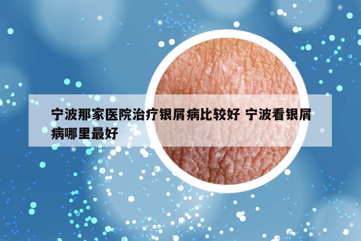宁波那家医院治疗银屑病比较好 宁波看银屑病哪里最好