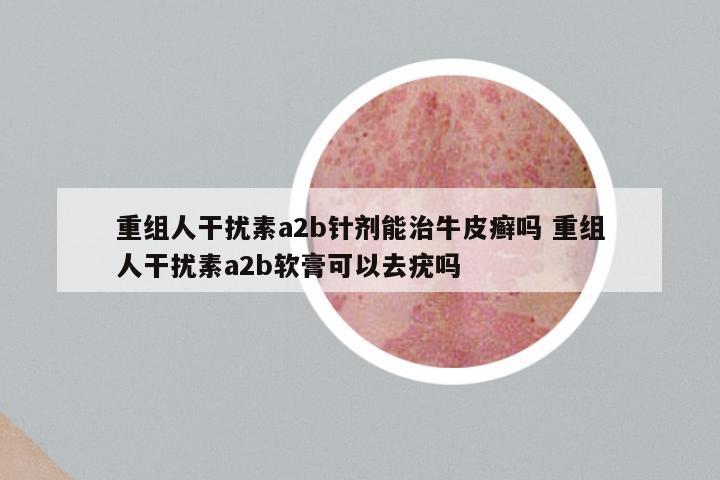 重组人干扰素a2b针剂能治牛皮癣吗 重组人干扰素a2b软膏可以去疣吗