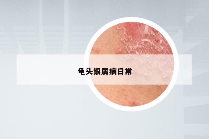 龟头银屑病日常