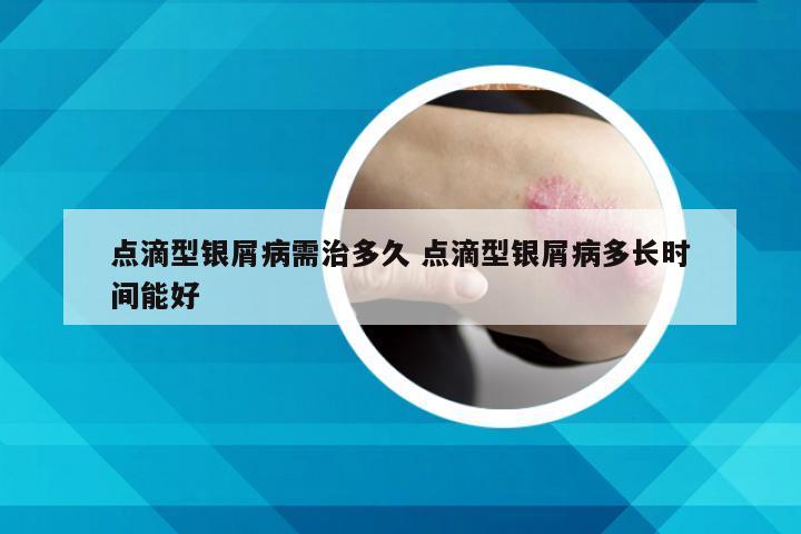 点滴型银屑病需治多久 点滴型银屑病多长时间能好